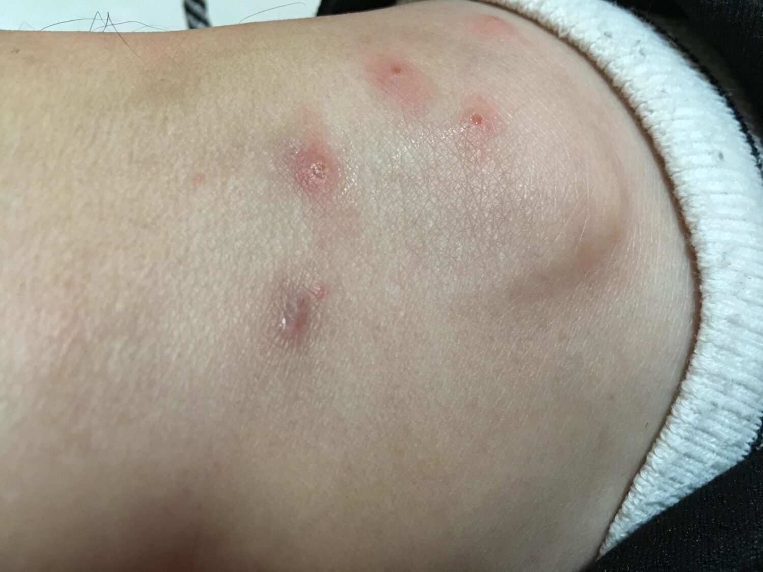 跳蚤（俗稱跳虱）叮咬後皮膚紅腫反應